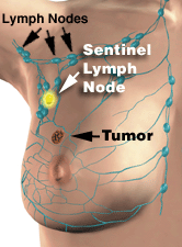 Pictures of Sentinel Lymph Node