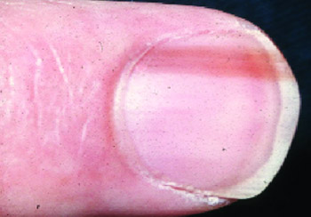 Picture 2 - Nail Matrix Disorder (Melanonychia)
