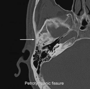 Image of Petrotympanic fissure