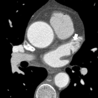 purpose of pectinate muscles heart