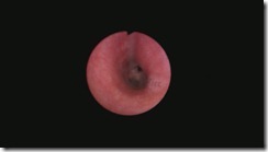 Image of Left Mainstem bronchus