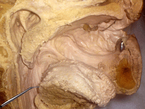 Image of Lingual tonsils
