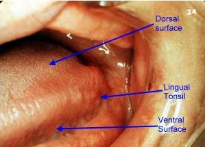 Picture of Lingual tonsils