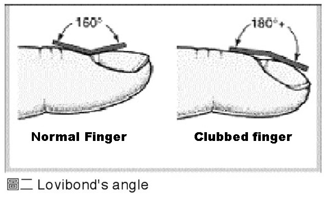Picture of Lovibond's angle