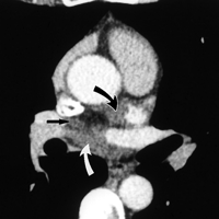 Image of Pericardial sinus