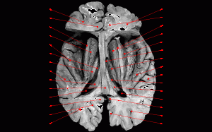 Image of Transverse temporal gyrus