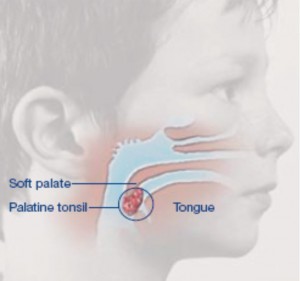 Photo of Palatine tonsil