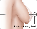 Picture of Inframammary fold