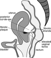 Image of Vaginal fornix