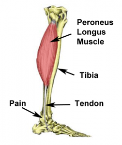 Peroneus longus Pain