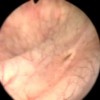 Image of Orifice of ureter