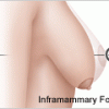 Picture of Inframammary fold