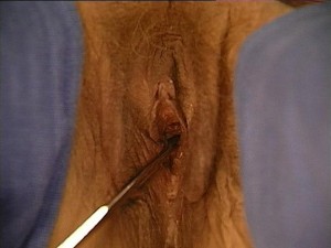 Image of Vaginal orifice