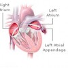 Picture of Left atrial appendage